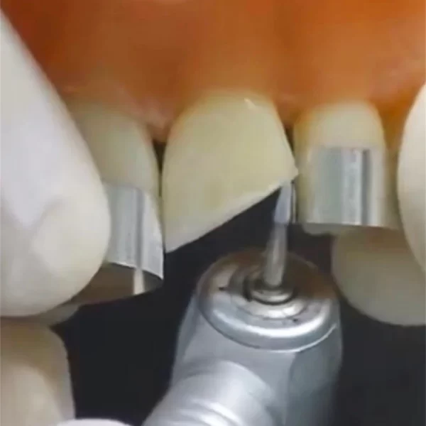 Tiras de matriz de acero inoxidable Dental, película de resina para restauración, bandas de matriz transparentes de resina curada, tira de pulido, Material Dental - AliExpress 66 - Image 4